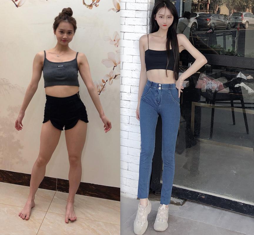 女性腰腹吸脂手术全过程,肥胖的人可以吸脂减肥吗