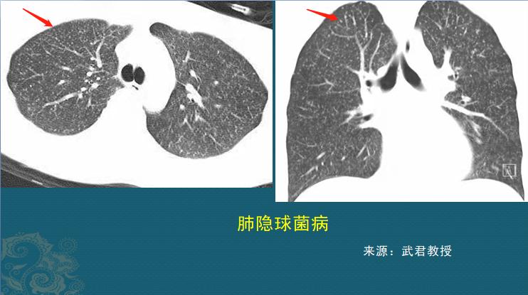 这种病菌1亿年前就有了，后来地球出现人类，它又学会了感染人肺
