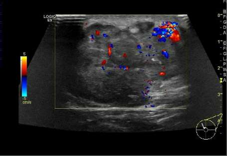 乳腺恶性肿瘤彩超表现,乳腺结节良性恶性彩超对照图