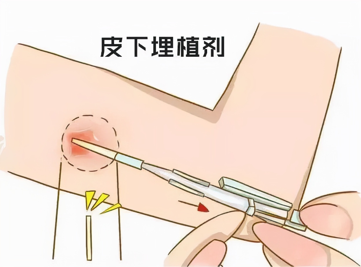 世界避孕日避孕这回事你了解多少,世界避孕日活动注意事项