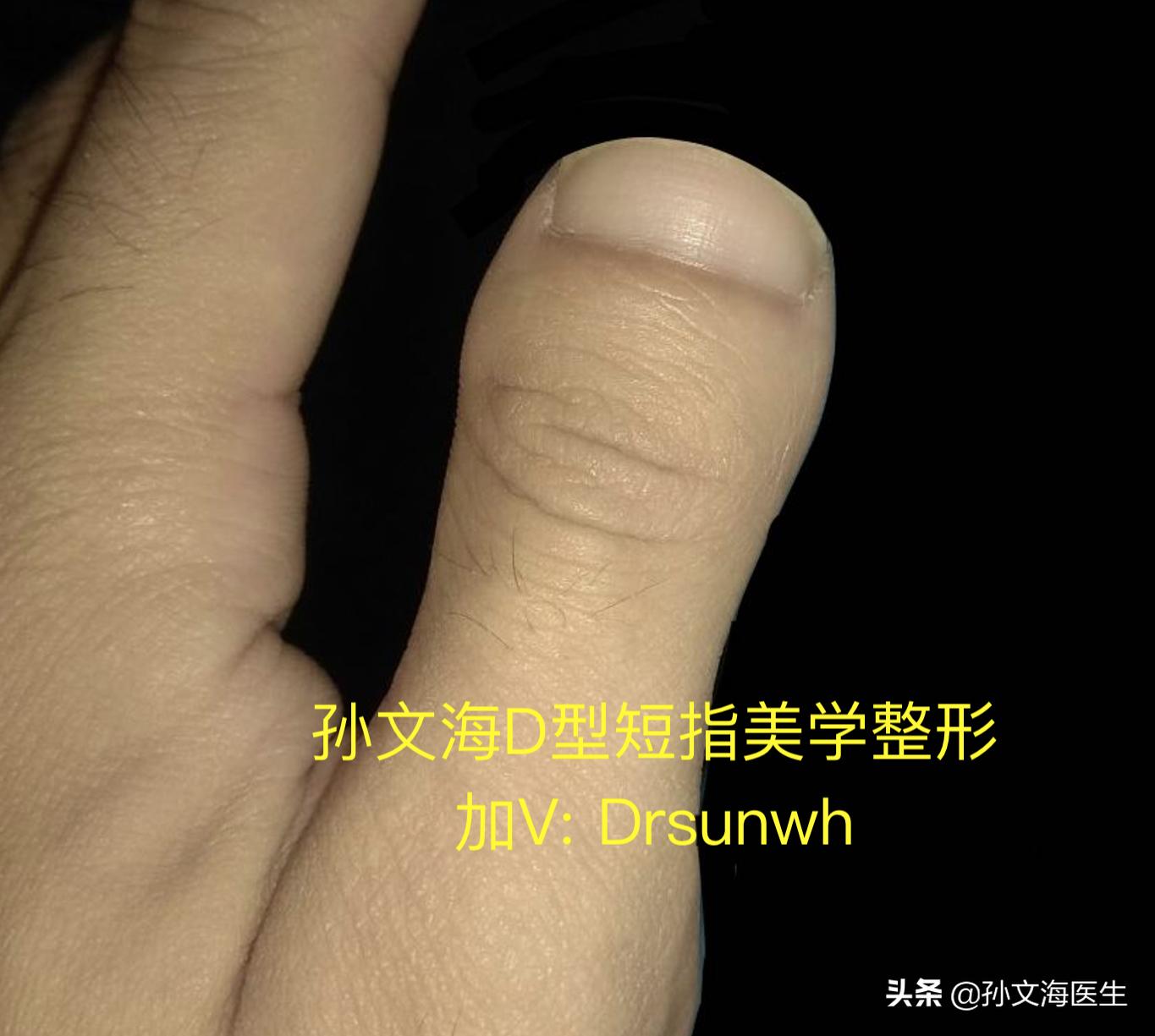 短指症大拇指矫正多少钱,大拇指短指症最佳治疗方案