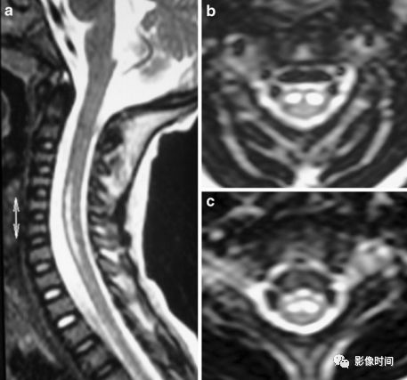 脊髓病变案例图文问诊,脊髓病变视频