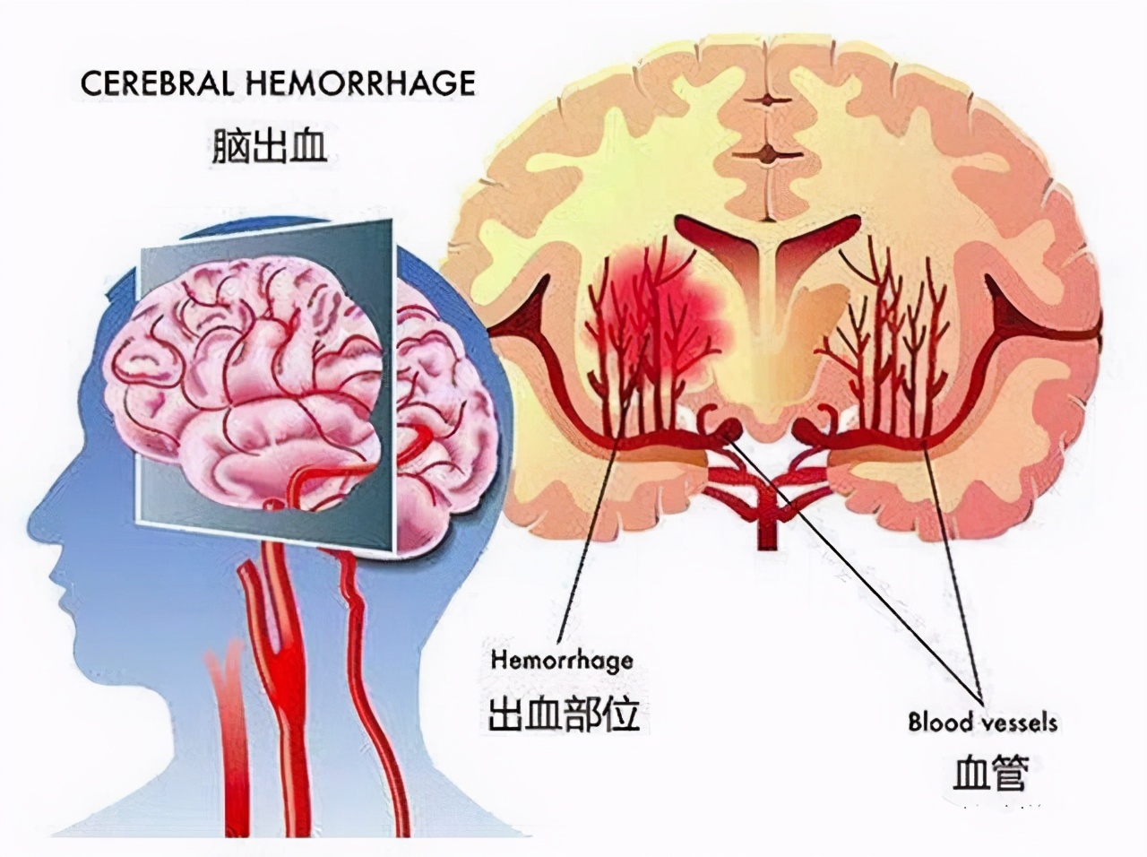 高血压脑出血急救视频,老年人突发脑出血应该怎么应急