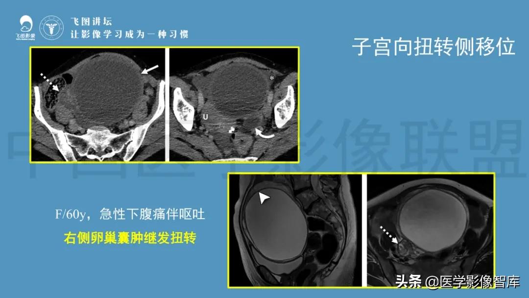 子宫解剖结构输卵管和卵巢位置,子宫附件ct影像学正常解剖表现