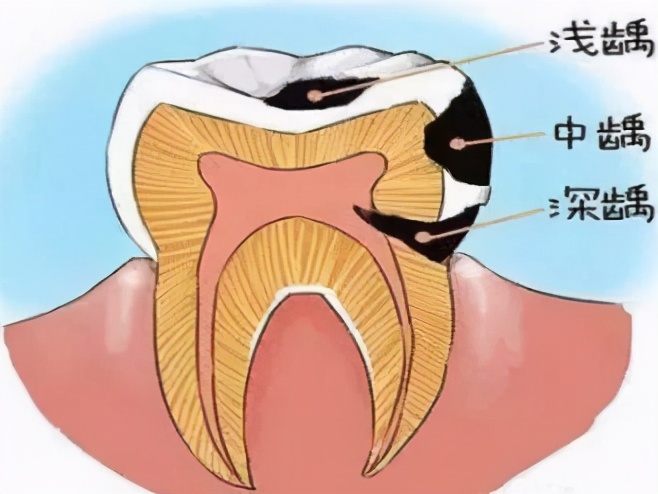 牙痛吃甲硝唑配阿莫西林可以吗,牙痛甲硝唑和什么药一起吃