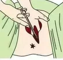 顺产时，自然撕裂、侧切哪个恢复快？有什么区别和影响？