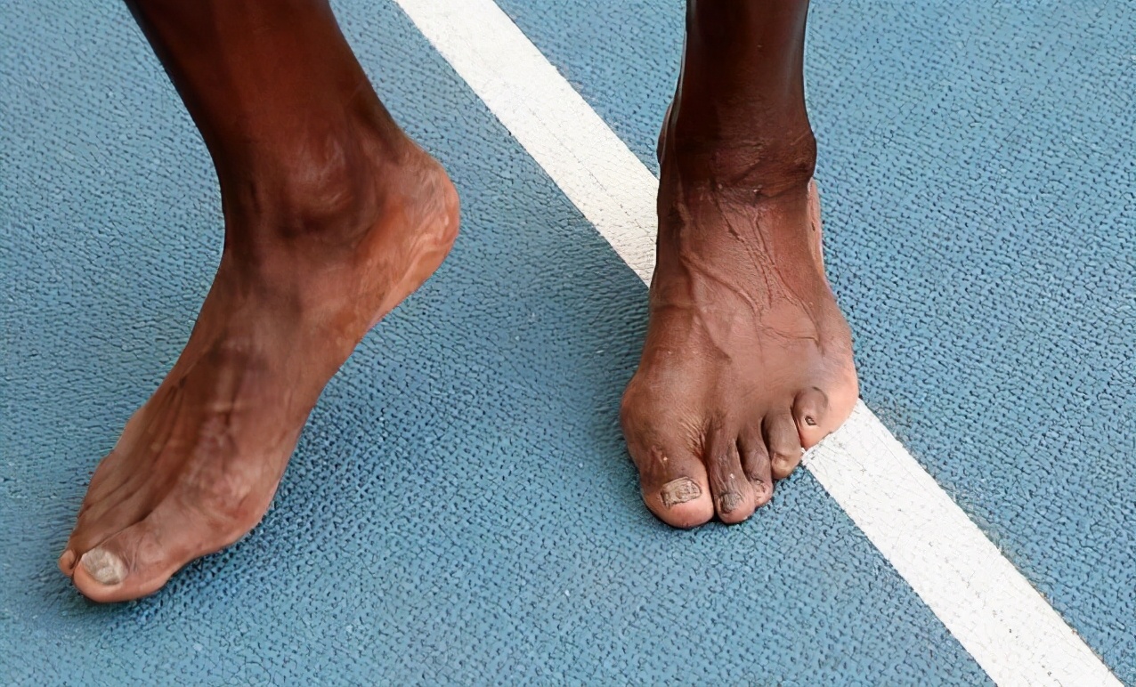 博尔特脚变形,博尔特现在变成了什么