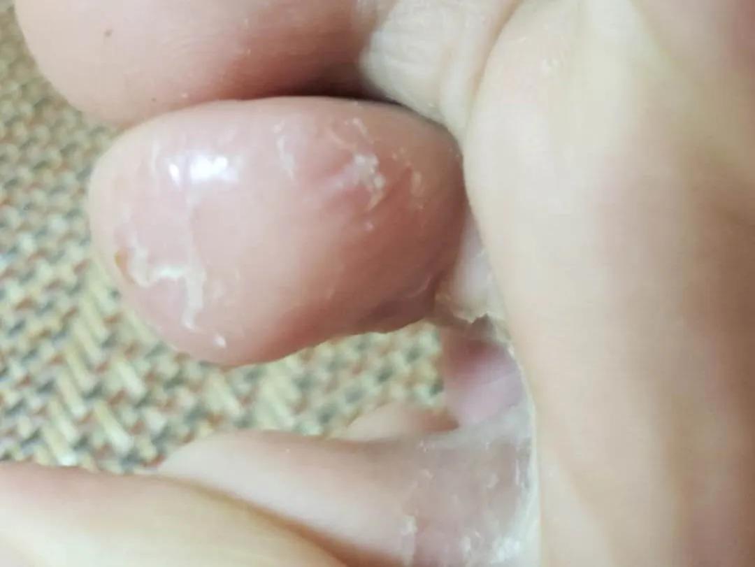 沈腾说醋的真实效果,沈腾治疗痘痘