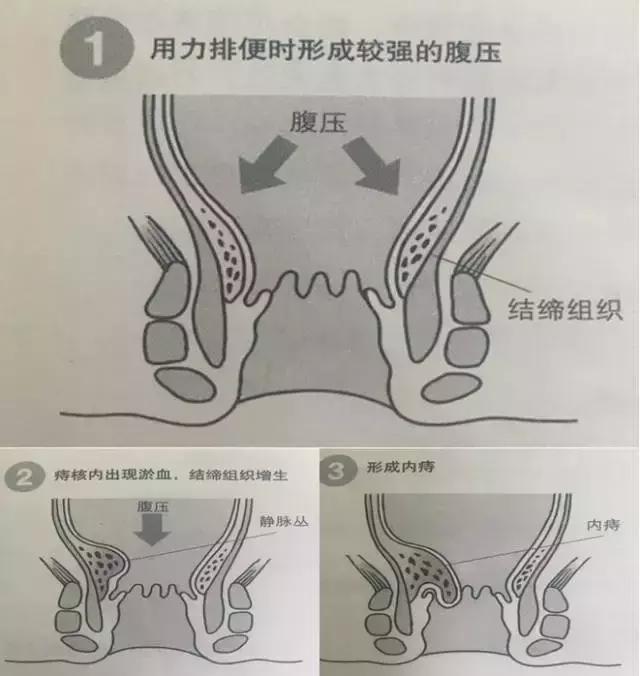 痔疮到底能疼多少天,痔疮到底能不能变小