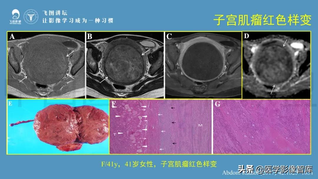 子宫解剖结构输卵管和卵巢位置,子宫附件ct影像学正常解剖表现