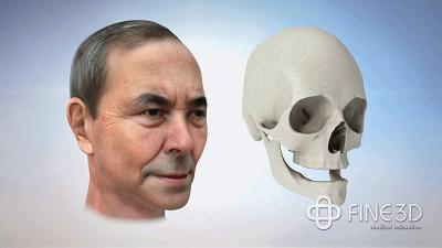 牙齿需要种植牙会经历几个步骤,种植牙流程什么情况需要做骨粉