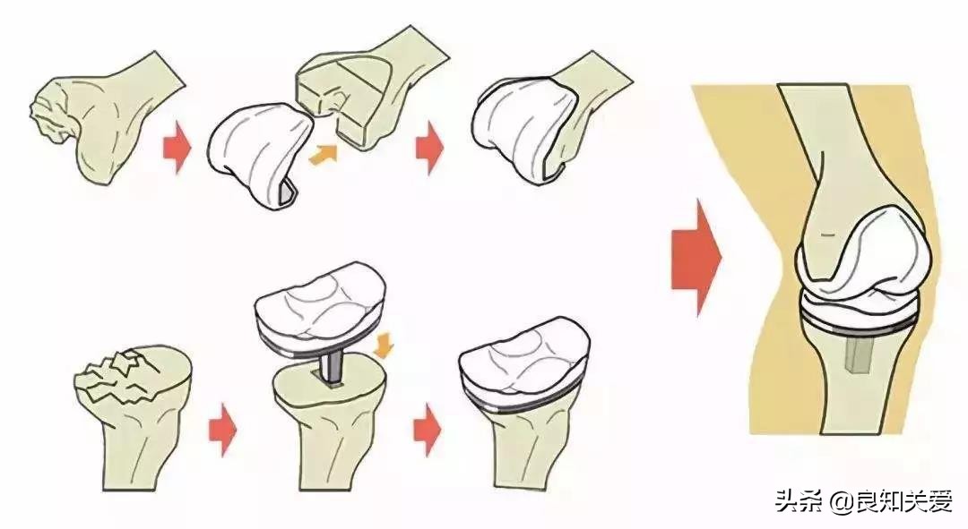 怎样练股四头肌保护膝关节,史冬泉医生如何保护膝关节