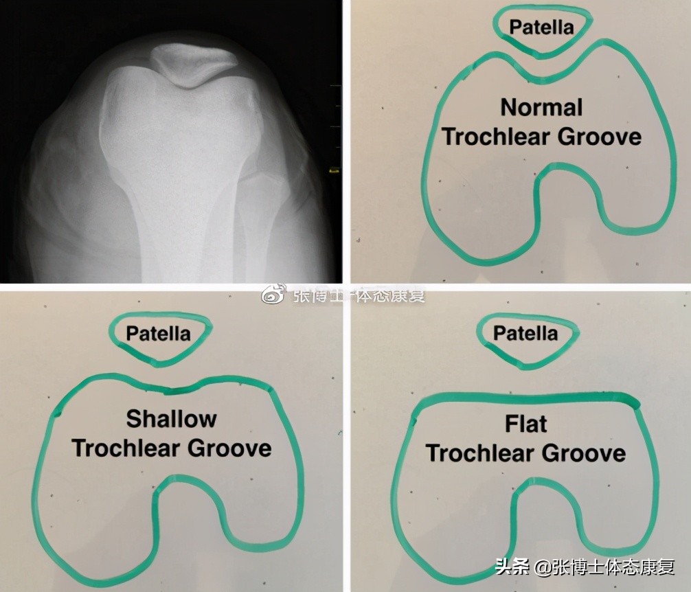 髌骨疼痛综合征康复训练,髌骨疼痛综合征是什么意思
