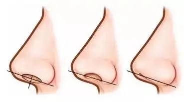 鼻子露鼻孔好看还是不露鼻孔好看,鼻孔大且外露是什么类型鼻子