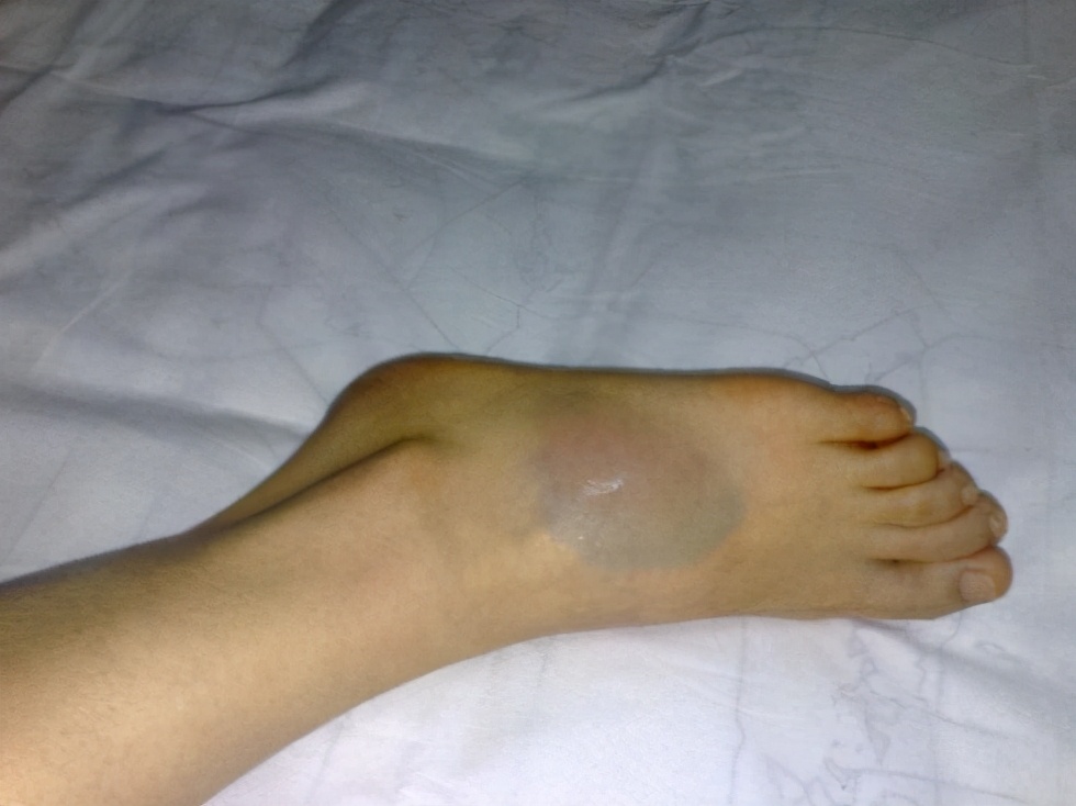 崴脚不当回事小心遗憾终生,崴脚时踝关节容易损伤的位置