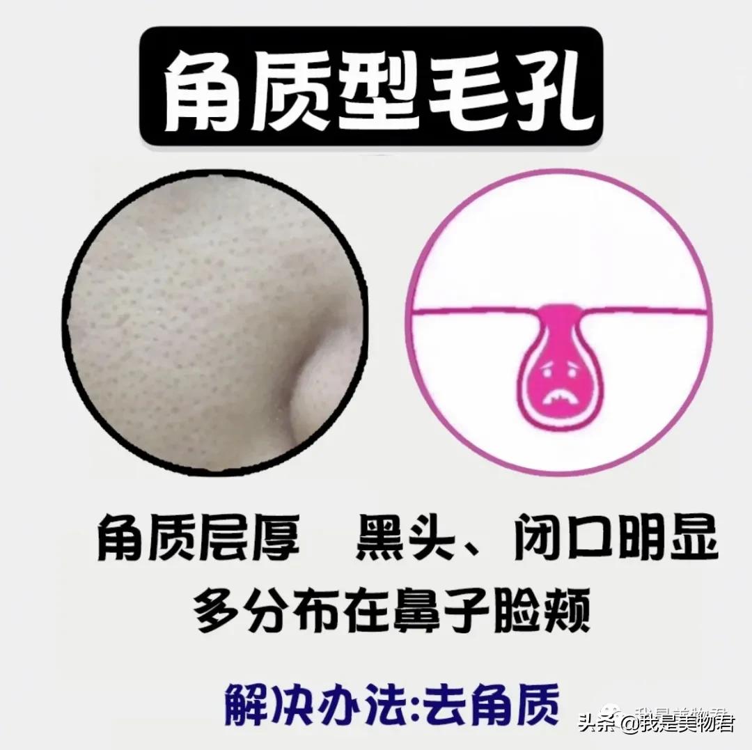 脸上毛孔粗大是什么原因引起的,脸上红血丝毛孔粗大是什么原因