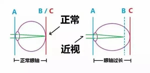 近视了可以恢复正常视力吗,视力近视300度能恢复吗