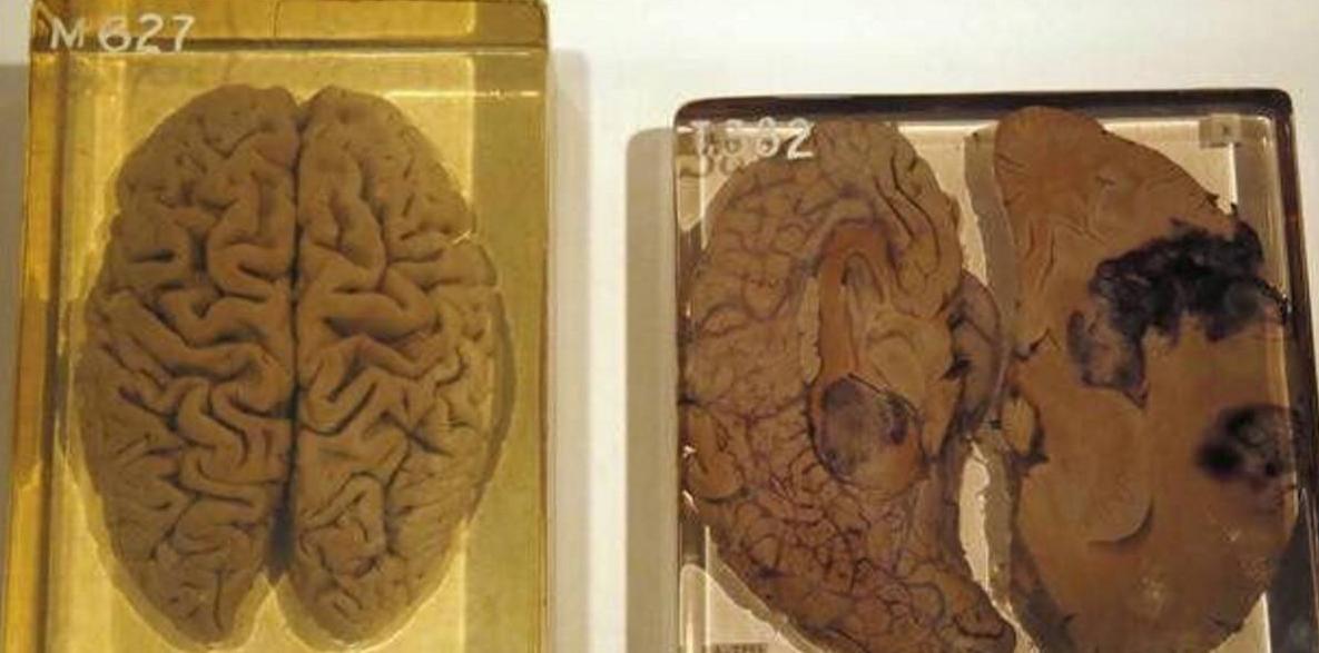 爱因斯坦死后的大脑被人偷走了吗,爱因斯坦死后大脑竟然被保留