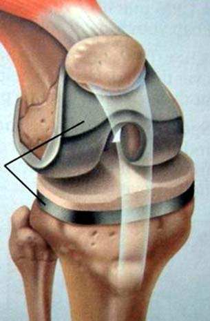 膝盖有骨刺和关节炎怎么治疗最好,膝关节长骨刺一冷就疼怎么治疗