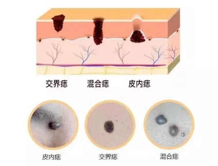 民间点痣最方便安全简单的偏方,街边的那些点痣是真的有效吗