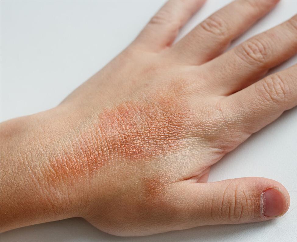 手臂有小红点是什么原因,手臂上出现很多小红点是什么原因