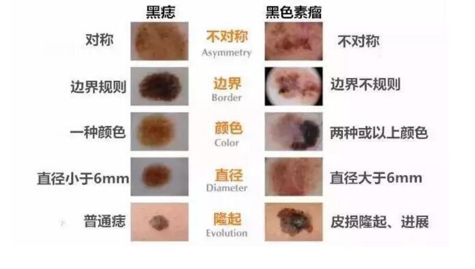 头上的黑色素瘤与黑色素痣的区别,怎么鉴别黑色素痣和黑色素瘤