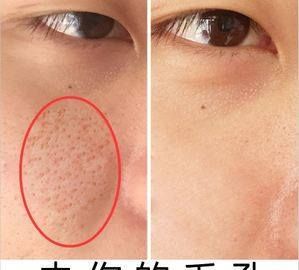 改善面部毛孔粗大方法,面部毛孔粗大如何改善男性