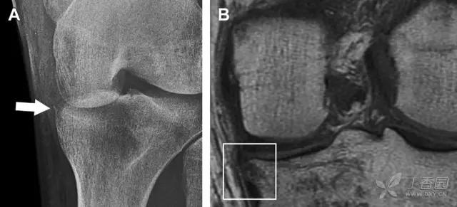 值夜班急救措施,放射科容易漏诊的骨折
