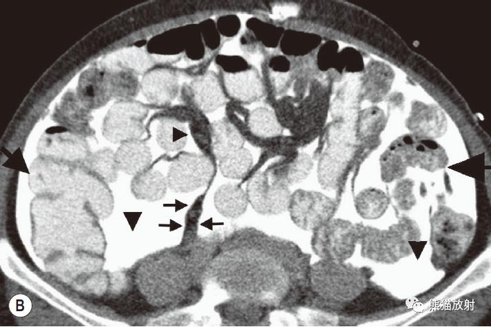 肠系膜解剖图,肠系膜解剖图解