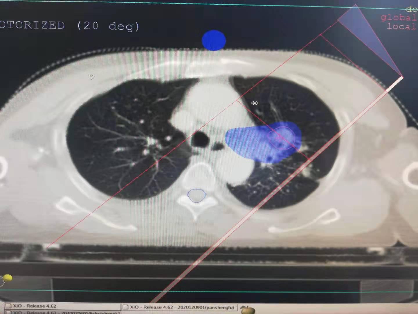 肺癌放疗后的放射性肺炎严重吗,放疗之后放射性肺炎多久能显现