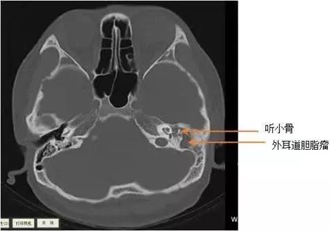 “耳屎”太多被同事吐槽！杭州漂亮姑娘去医院一查，吓得直掉眼泪