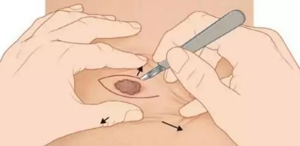 点痣最好是去什么机构,在广州点痣去什么机构点好