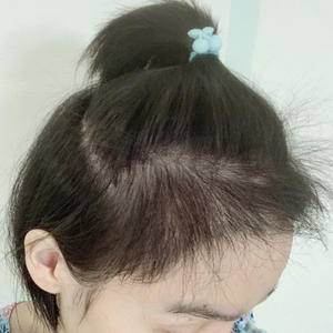 发际线太高怎么办,发际线太高怎么办做什么发型