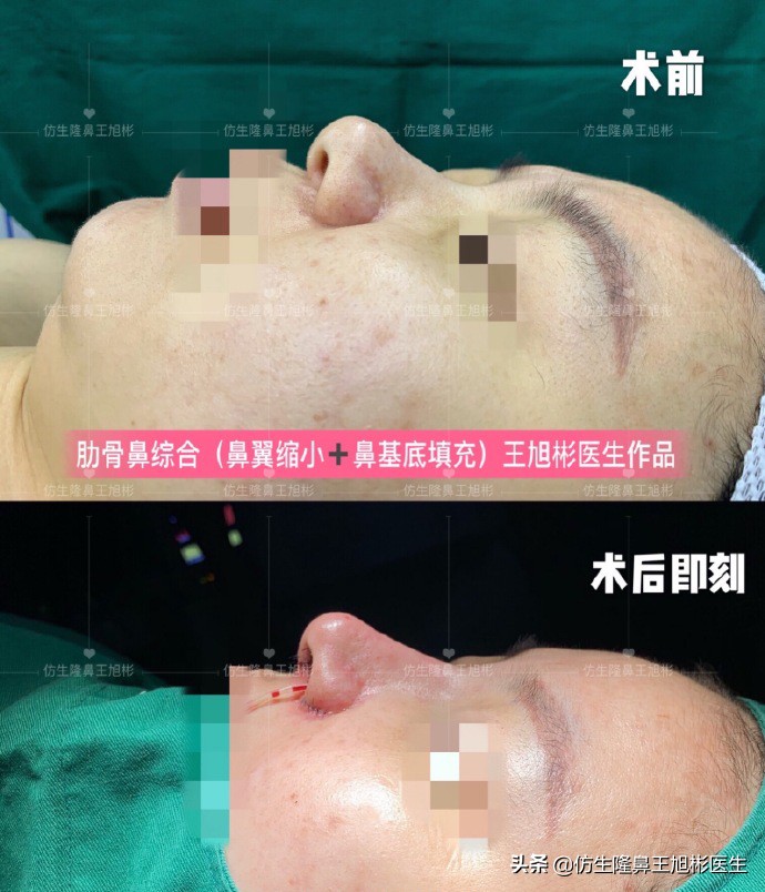 隆鼻鼻头大是失败了吗,大鼻头隆鼻手术案例