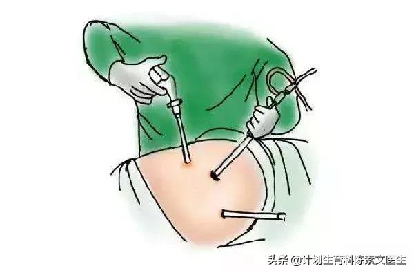 单孔腹腔镜包括哪些,3d腹腔镜与普通腹腔镜的开孔区别