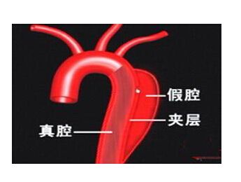 主动脉夹层为什么会这么凶险,异常凶险的心脏病主动脉夹层