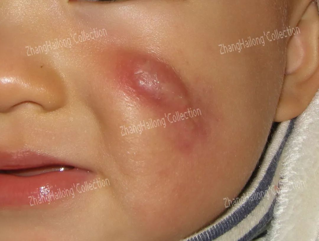 新生儿青春痘,小孩长青春痘怎么办