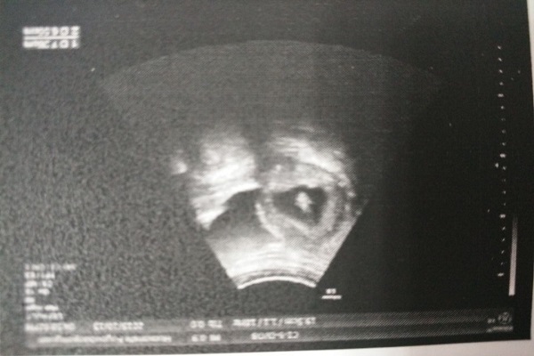 孕妇能做b超需要憋尿吗,孕期b超检查都是阴超么