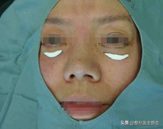 泪沟都到脸颊了怎么办,泪沟眼袋越来越严重怎么办