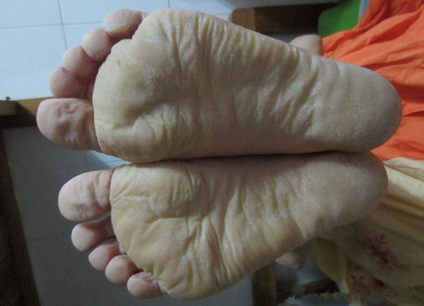 教你十招治疗脚气的方法,治疗脚气的几个误区看你中招了吗