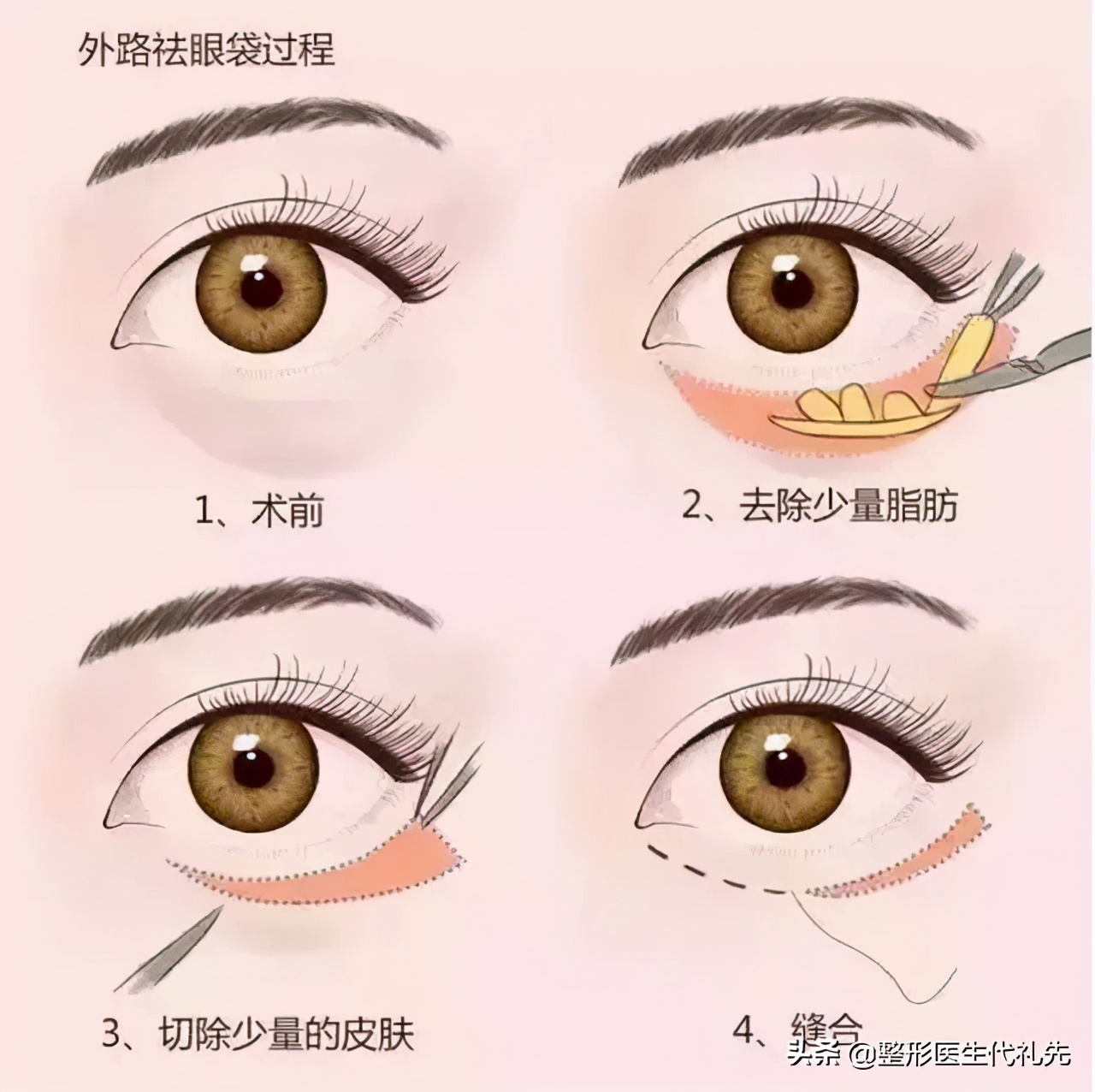 外切祛眼袋和内切祛眼袋哪个好些,超声祛眼袋好还是射频祛眼袋好呢