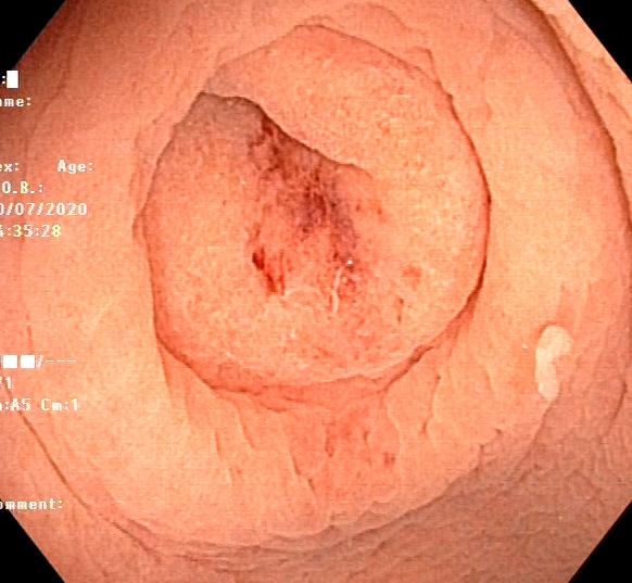 怎么让阑尾炎不复发,不开刀也能治愈阑尾炎