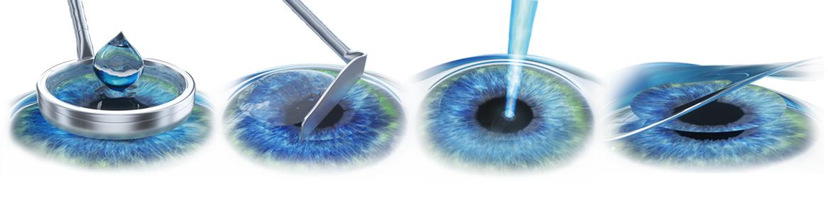 激光治疗近视眼手术十大危害,近视眼激光手术有什么风险和危害