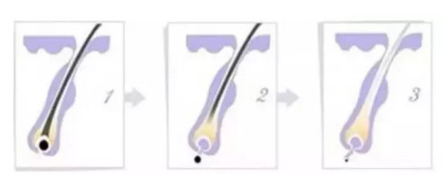 光子脱毛和激光脱毛哪个好,光子脱毛和光子嫩肤仪器区别