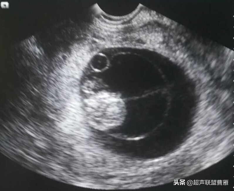 内见卵黄囊,卵黄囊肿瘤