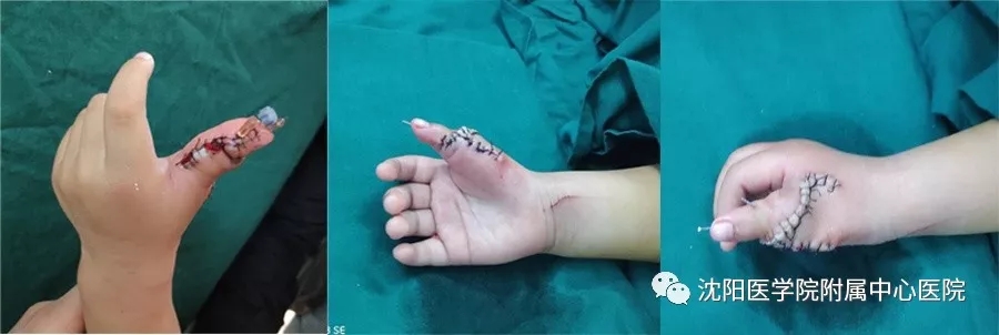 完美矫治畸形双手——沈医中心医院为先天有14根手指的小女孩成功再造健康双手