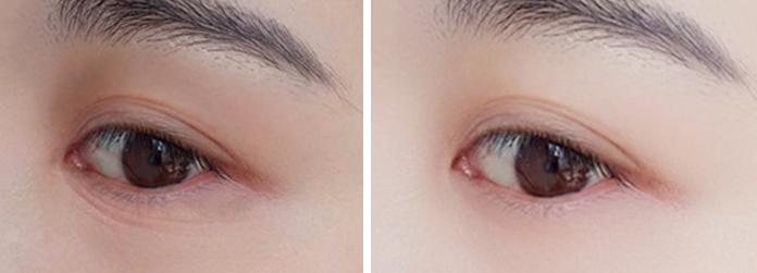 眼部最近出现了细纹怎么办,眼部细纹突然多