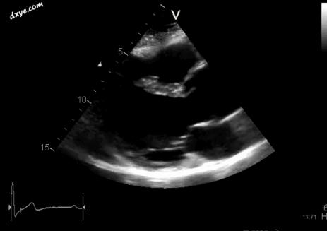 马凡综合征面容,马凡综合征最新标准