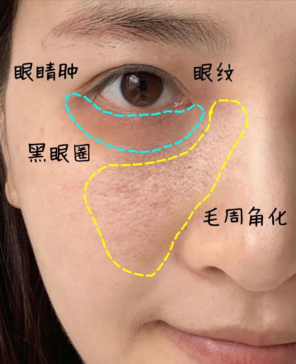 平价祛痘好物测评：理肤泉K乳见效快，红霉素软膏去闭口超赞