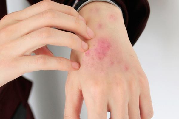 有什么虫没害但是能引发皮肤病,引起皮肤白斑的虫子